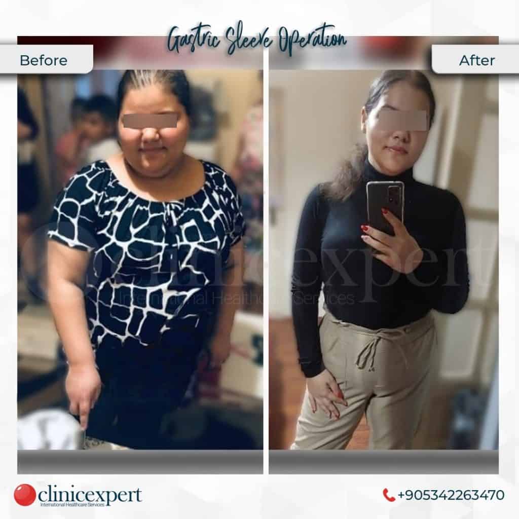 what-to-expect-3-months-after-gastric-sleeve-clinicexpert