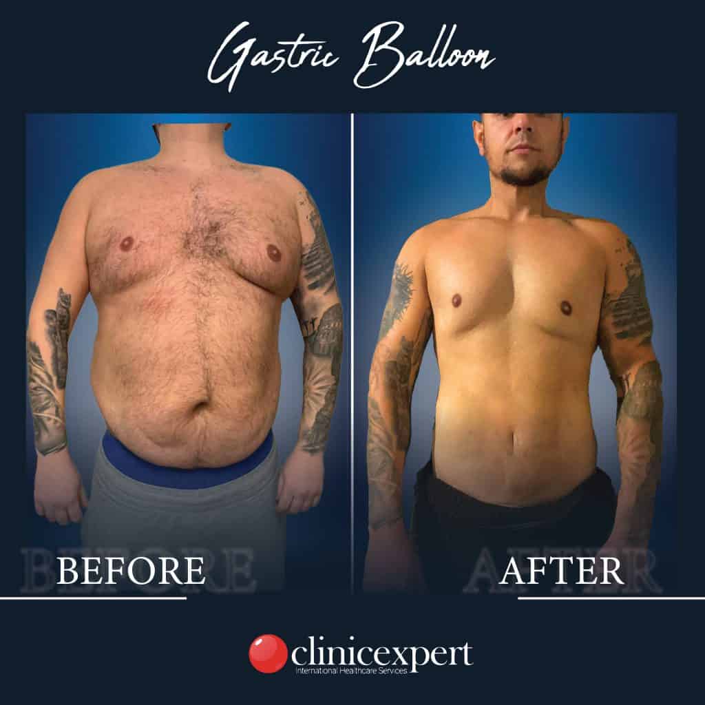 Before and After a Gastric Balloon Procedure | ClinicExpert