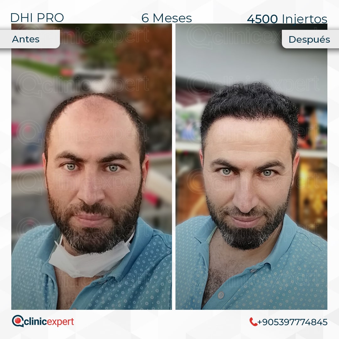 Hair Transplant