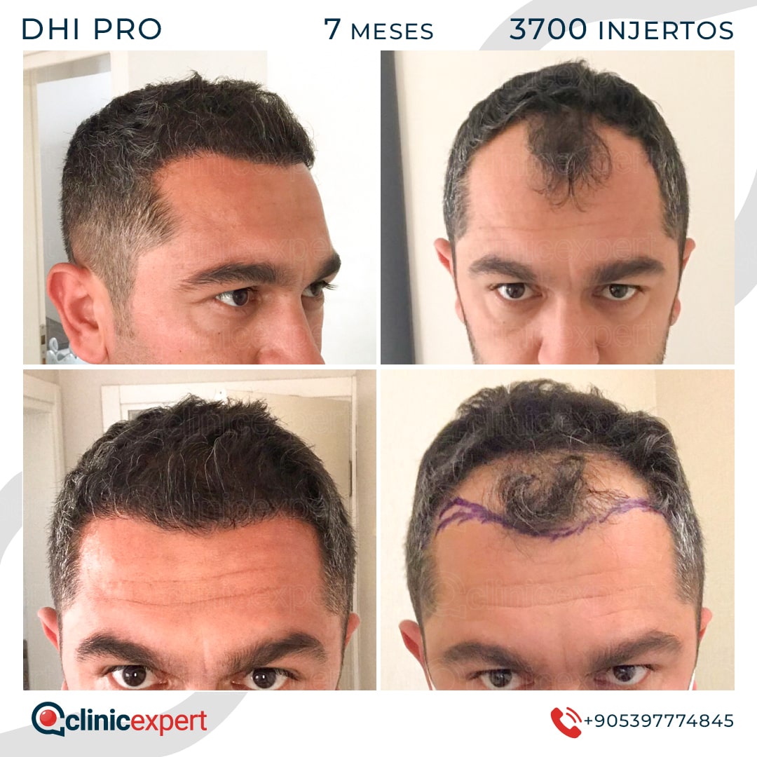 Hair Transplant
