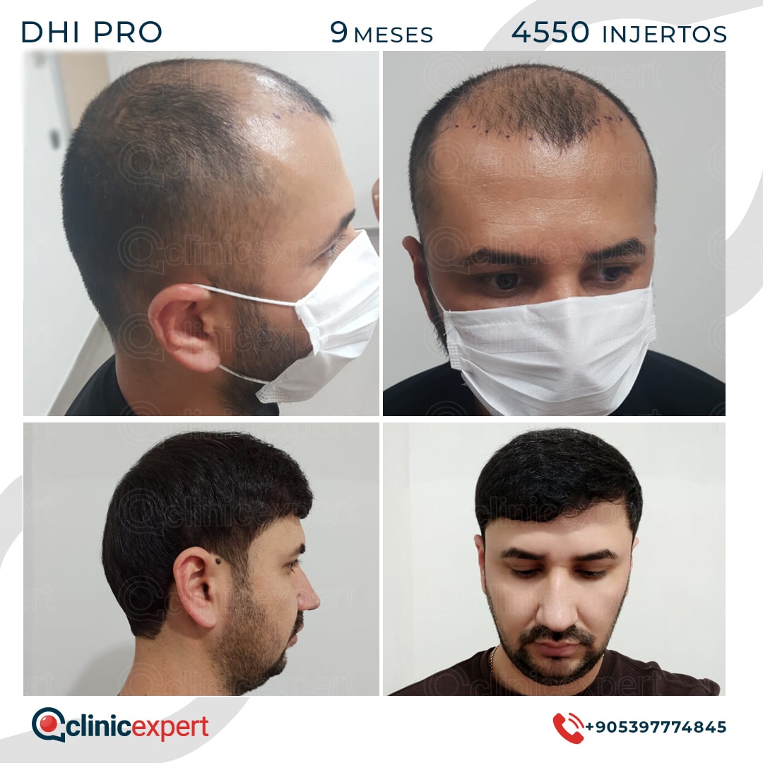 Hair Transplant