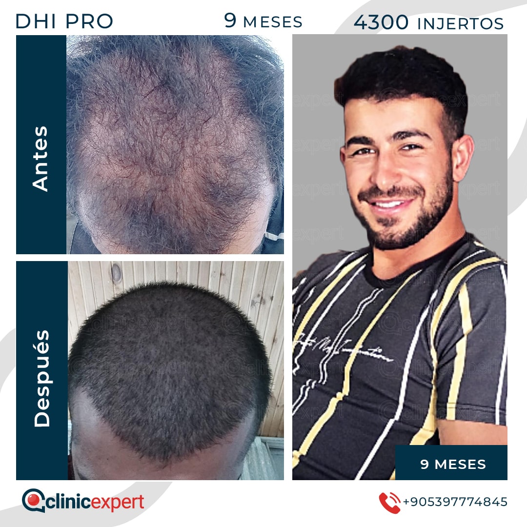 Hair Transplant