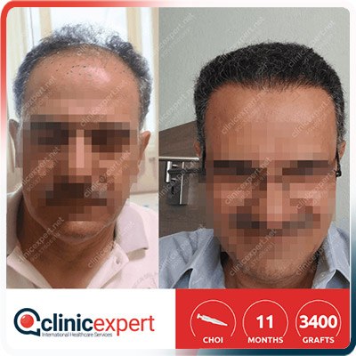 Implantation De Cheveux