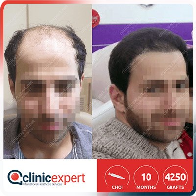 Implantation De Cheveux