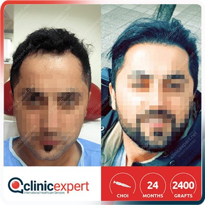 Implantation De Cheveux