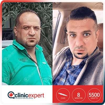 greffe de cheveux turquie Implantation De Cheveux