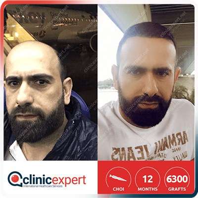 greffe de cheveux turquie Implantation De Cheveux