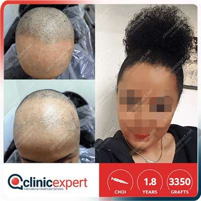 greffe de cheveux turquie Implantation De Cheveux