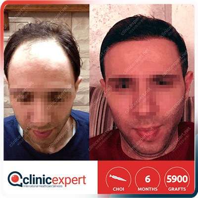 implant cheveux turquie Implantation De Cheveux