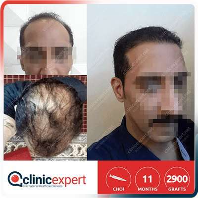 implant cheveux turquie Implantation De Cheveux