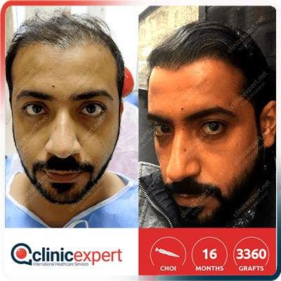 Implantation De Cheveux Implantation De Cheveux