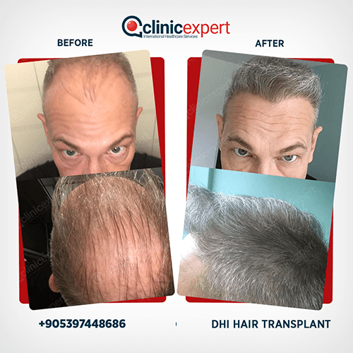 Hair Transplant Hair Transplant