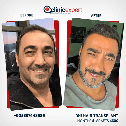 Hair Transplant Hair Transplant