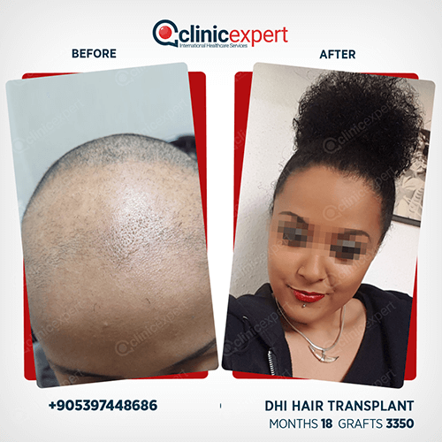Hair Transplant Hair Transplant