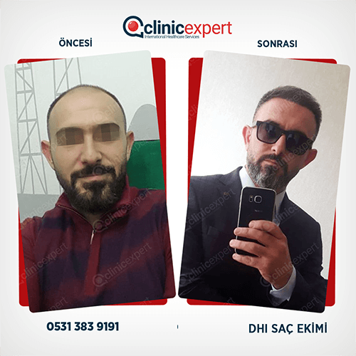 Hair Transplant Hair Transplant