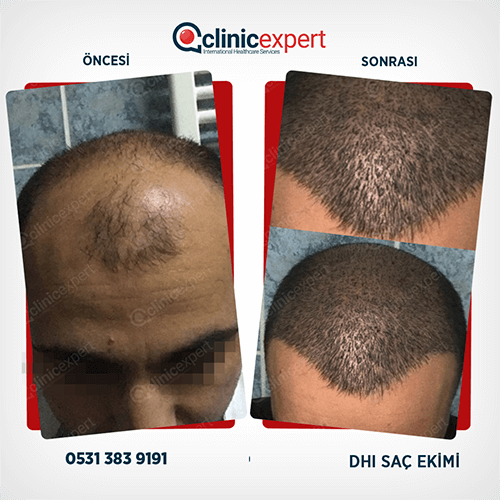 Hair Transplant Hair Transplant