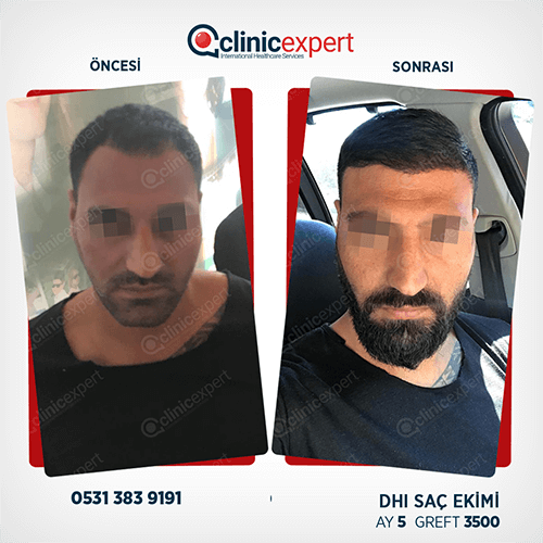 Hair Transplant Hair Transplant