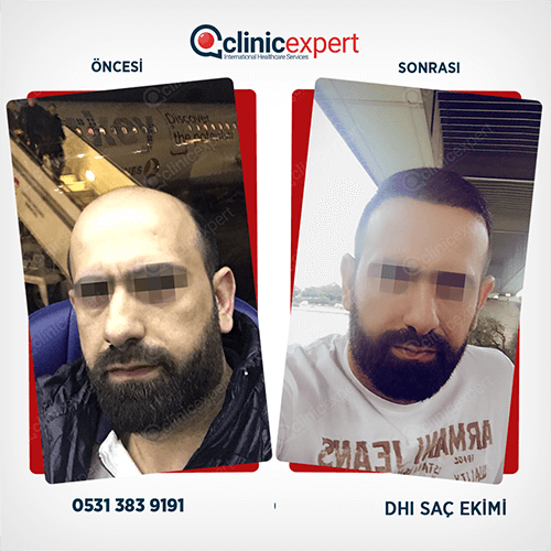 Hair Transplant Hair Transplant