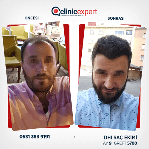 Hair Transplant Hair Transplant