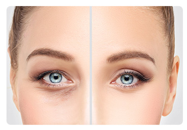 GÖZ KAPAĞI ESTETİĞİ GÖZ KAPAĞI ESTETİĞİ