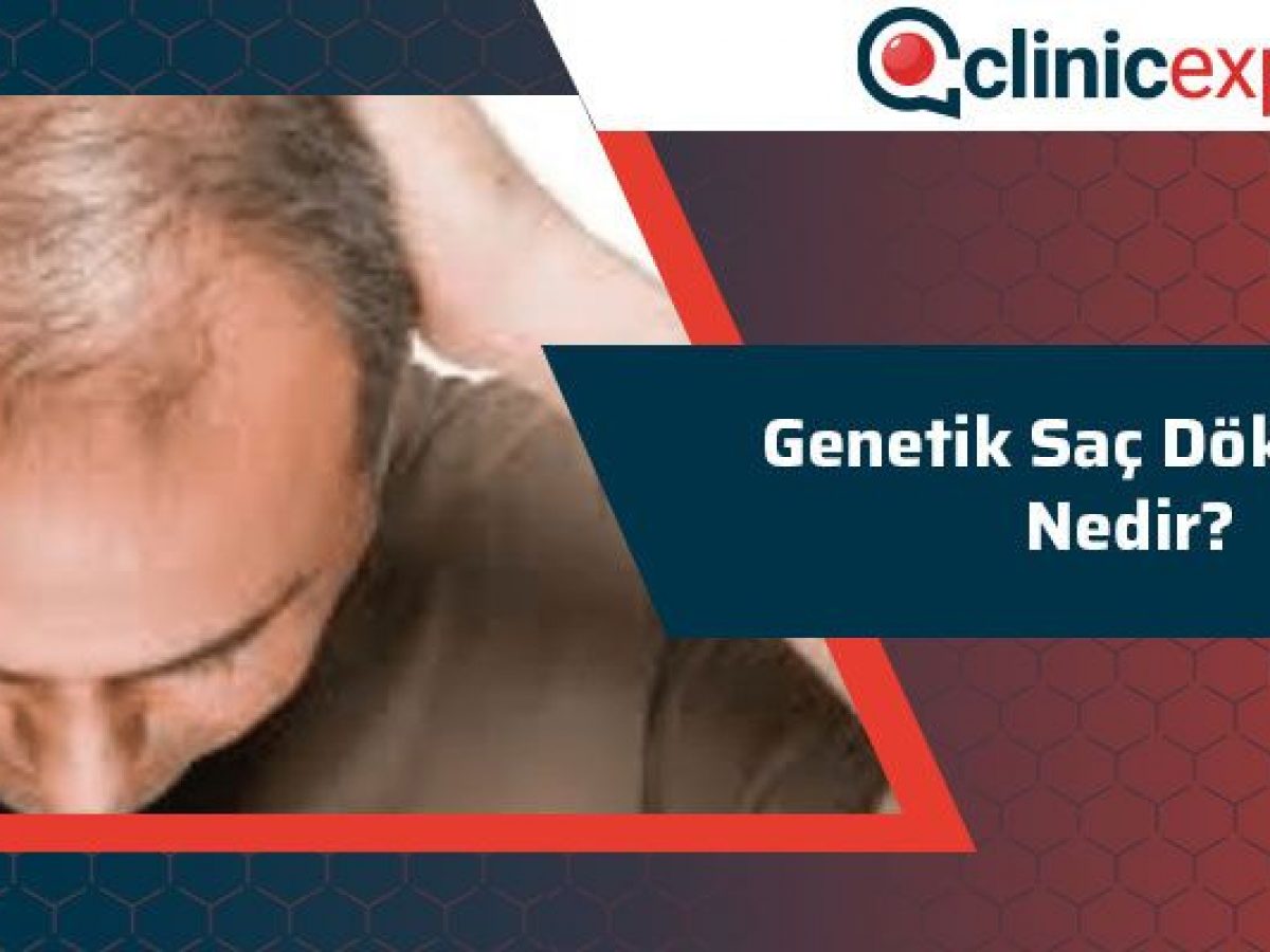 Genetik Sac Dokulmesi Nedir Clinicexpert Sac Ekim Merkezi