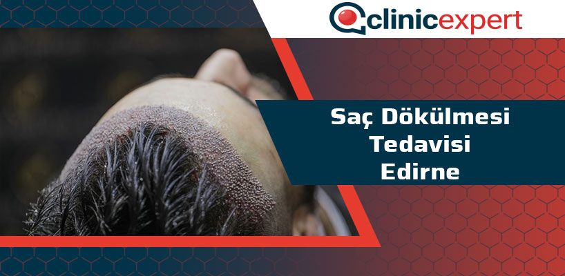 sac dokulmesi tedavisi edirne clinicexpert uluslararasi saglik hizmetleri