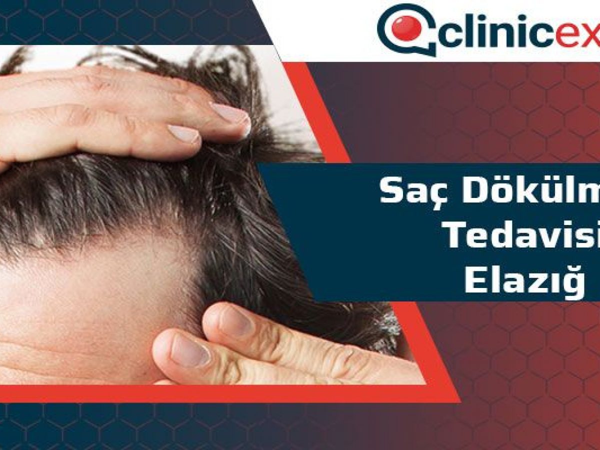 sac dokulmesi tedavisi elazig clinicexpert uluslararasi saglik hizmetleri