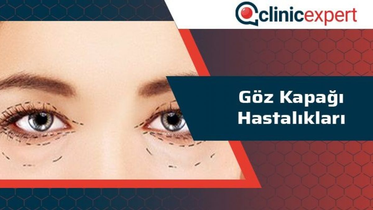 Goz Kapagi Hastaliklari Clinicexpert Uluslararasi Saglik Hizmetleri