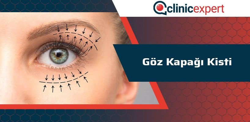 Goz Kapagi Kisti Clinicexpert Estetik Merkezi