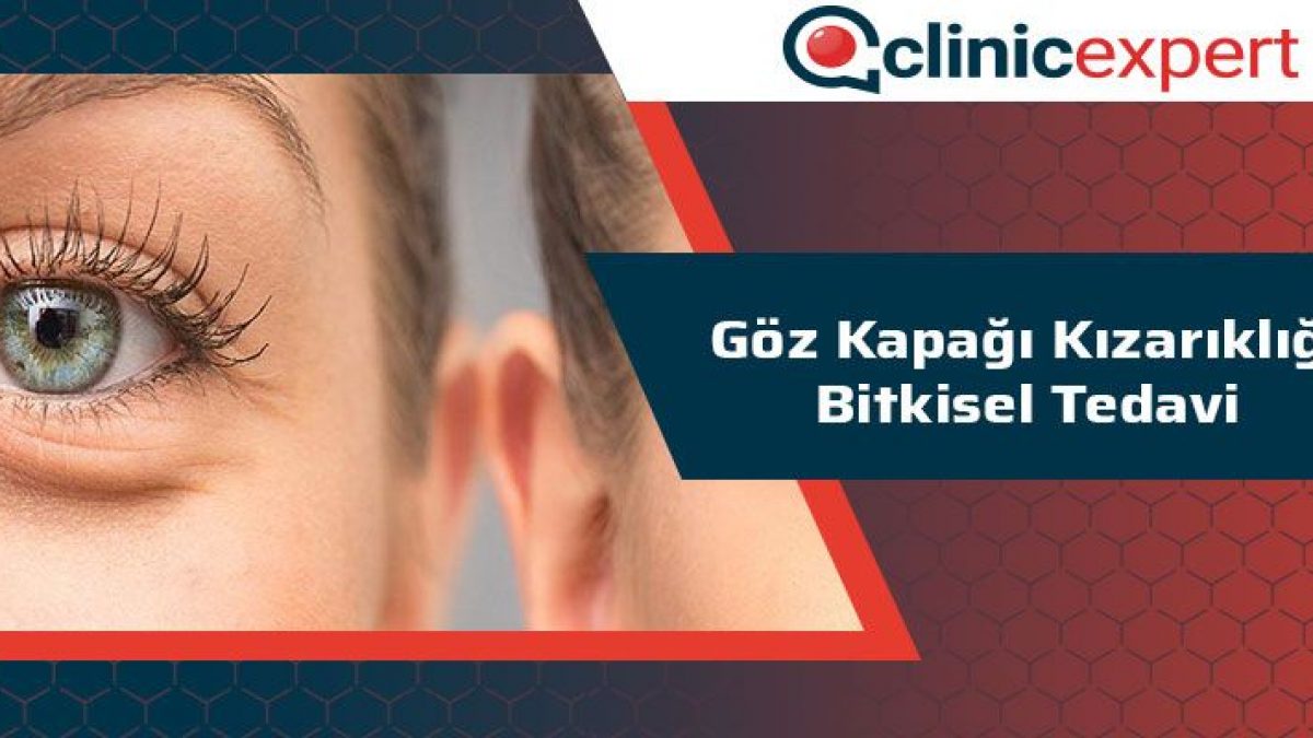 Goz Kapagi Kizarikligi Bitkisel Tedavi Clinicexpert