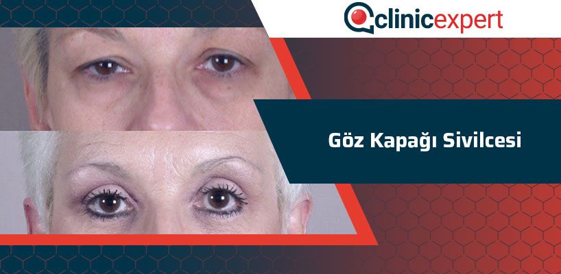 Goz Kapagi Sivilcesi Clinicexpert Uluslararasi Saglik Hizmetleri