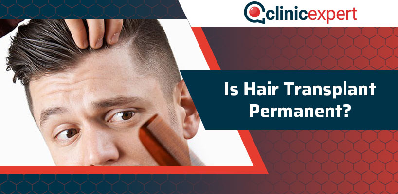 Is Hair Transplant Permanent?