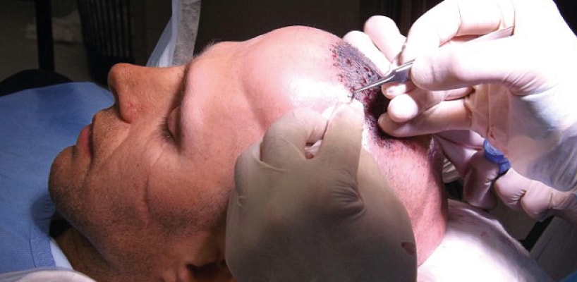Hair Transplant Turkey Reviews