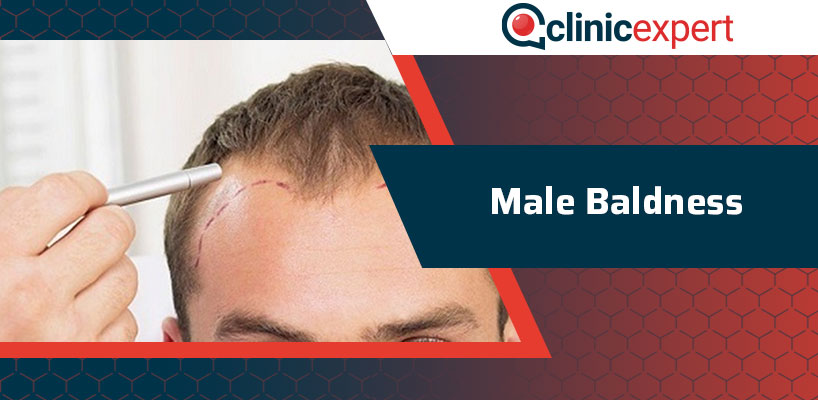 Male Baldness