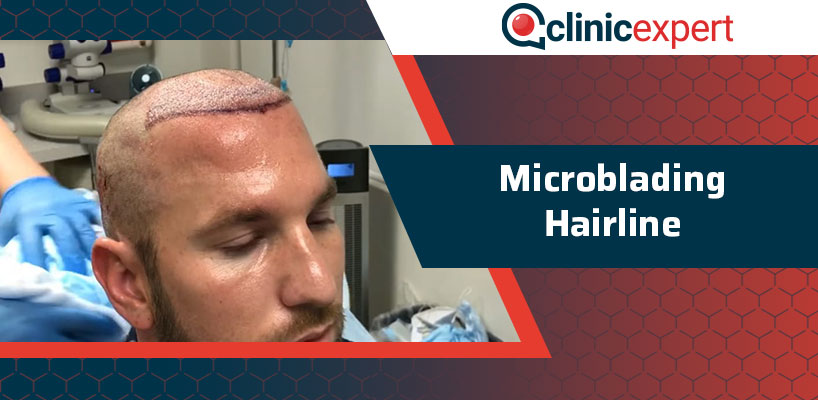 Microblading Hairline