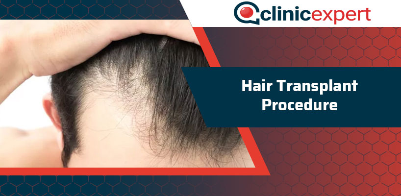 Hair Transplant Procedure