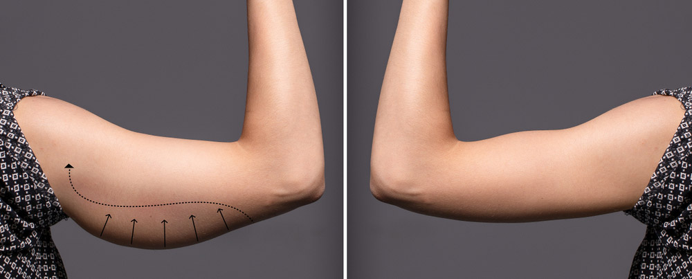 arm-lipo