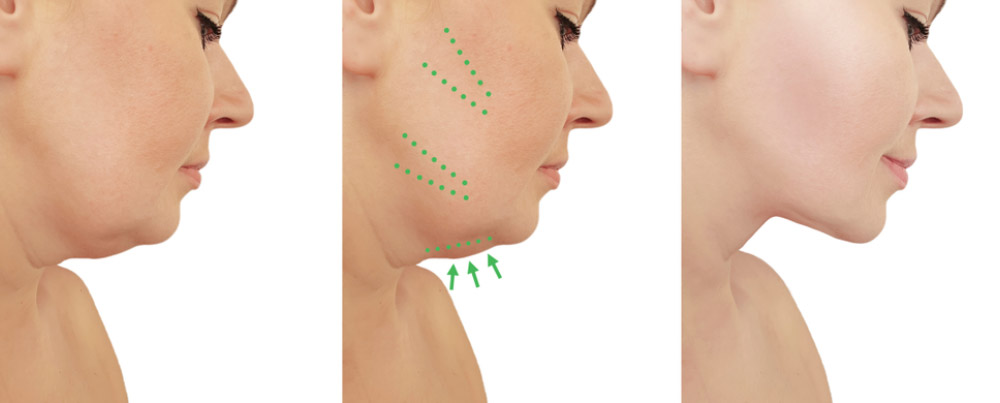 chin-liposuction
