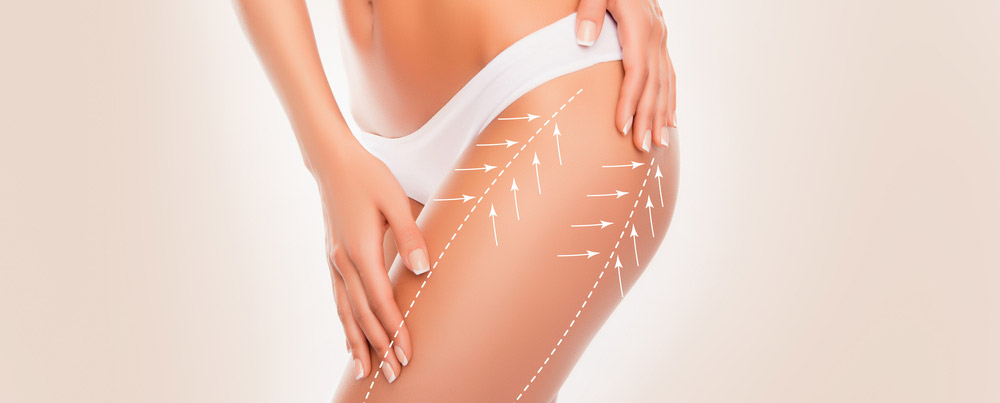 leg-liposuction