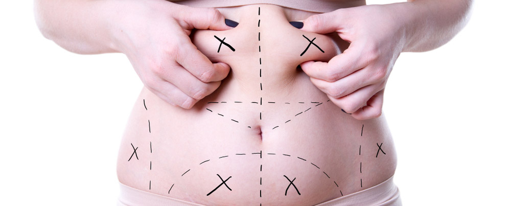 stomach-liposuction