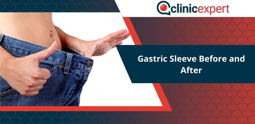 Gastric Sleeve Before and After
